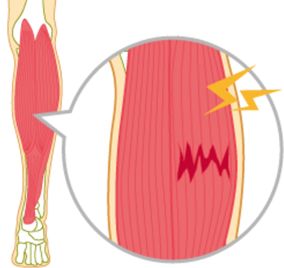 肉離れのイメージ