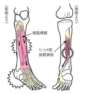 シンスプリントのイメージ