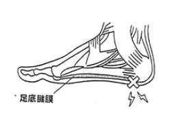 足底筋膜炎のイメージ